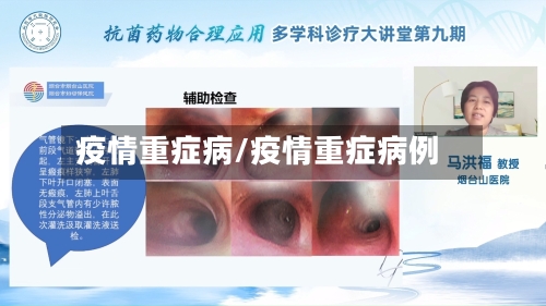 疫情重症病/疫情重症病例-第2张图片