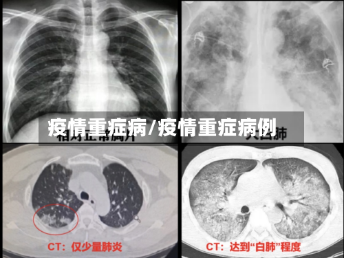 疫情重症病/疫情重症病例
